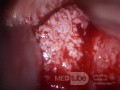 Zervikales Adenokarzinom (Carcinoma glandulare colli uteri)