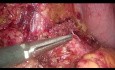  Laparoskopische Enukleation des Pankreas-Insulinoms – Video in voller Länge