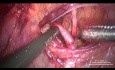 Präparation und Ligatur der A. uterina
