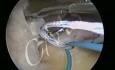 Arthroskopische Rekonstruktion der Rotatorenmanschette
