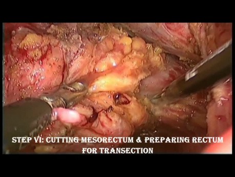 Laparoskopische tiefe anteriore Resektion