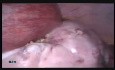Die große Ovarialzyste in der Schwangerschaft  (18. Schwangerschaftswoche)- die Laparoskopie