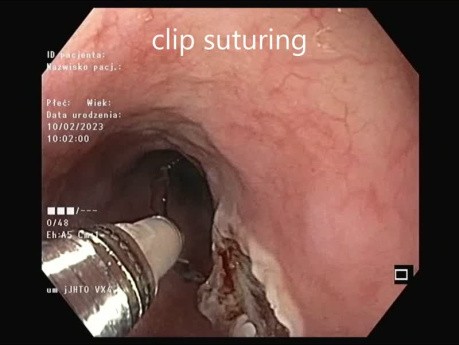 Resektion eines submukösen Tumors der Speiseröhre