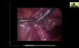 Laparoskopie bei Eileiterschwangerschaft - Tubal Milking
