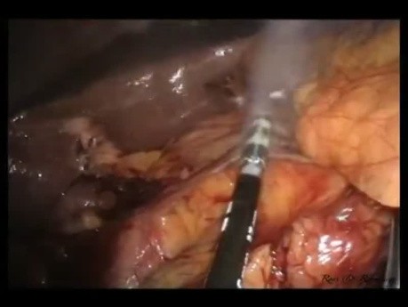 LESS-Chirurgie: Hemikolektomie rechts