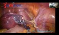Schnellste und sicherste laparoskopische Hysterektomie