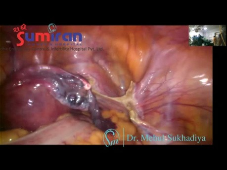 Schnellste und sicherste laparoskopische Hysterektomie