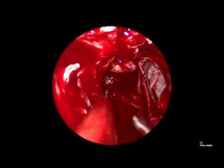 Endoskopischer transnasaler Zugang zur Resektion eines Hypophysenmikroadenoms bei einem Patienten mit Akromegalie