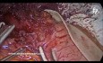 Laparoskopische Heller-Myotomie und Fundoplicatio nach Dor
