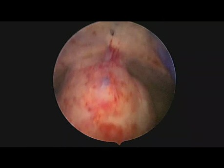4 cm große submuköse Myomentfernung mit Resektoskop