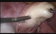 Laparoskopische Myomektomie- ein Myom an der hinteren Gebärmutterwand
