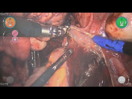 Nähen mit dem Versius-Roboter – Endometriose