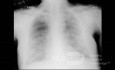 COVID-19- Röntgen-Thorax (4)