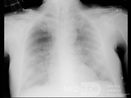 COVID-19- Röntgen-Thorax (4)