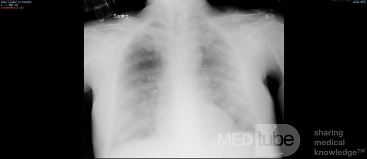 COVID-19- Röntgen-Thorax (4)
