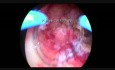 Monopolare Resektion von einem adenomatösen Polyp des Endometriums