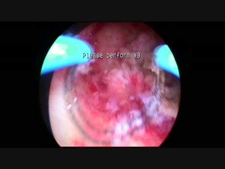 Monopolare Resektion von einem adenomatösen Polyp des Endometriums