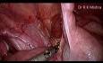 Appendektomie wegen Appendicitis eines Kindes