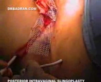 Hintere intravaginale Schlingenplastik
