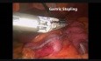 Sleeve-Gastrektomie- Schritt für Schritt