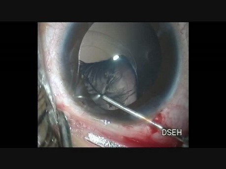 Linsenimplantation bei Ectopie lentis