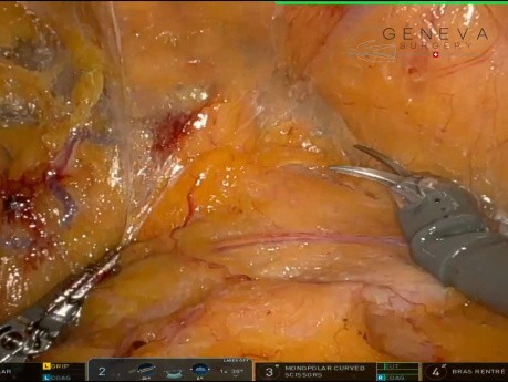 Robotische R-TAPP – bilaterale Leistenhernienreparation