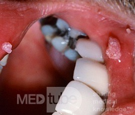 Papillom der Lippe