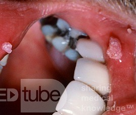 Papillom der Lippe