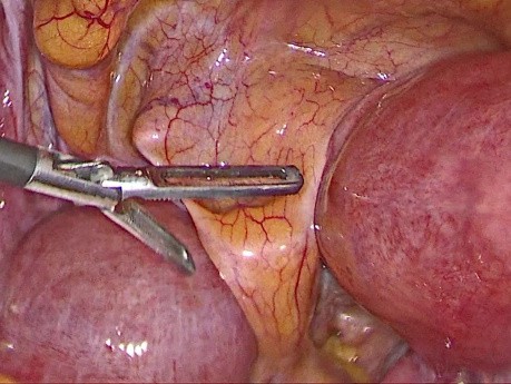 Totale laparoskopische Hysterektomie bei dem Uterus bicornis