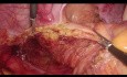 Laparoskopische intersphinktäre Resektion beim intraanal gelegenen Rektumkarzinom - vollständiges Video