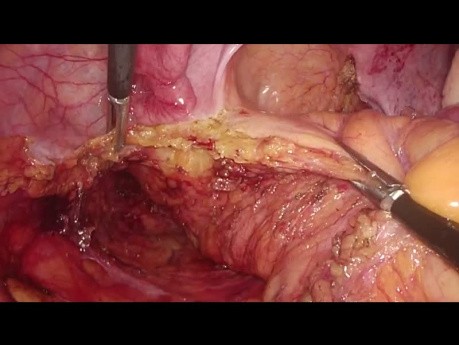 Laparoskopische intersphinktäre Resektion beim intraanal gelegenen Rektumkarzinom - vollständiges Video