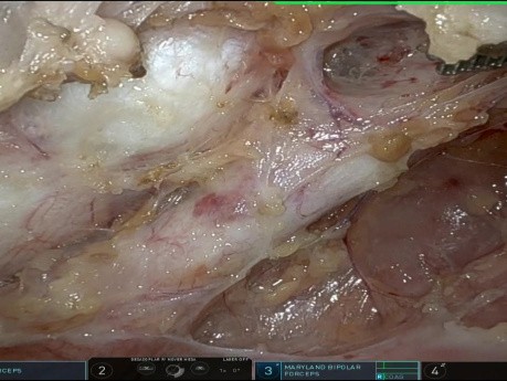 Mediastinaler Tumor bei einem Kind