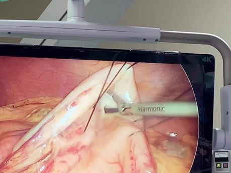 Endoskopische retrograde Cholangiopankreatikographie (ERC) mit Laparoskopie bei einem Patienten nach Magenbypass-Operation