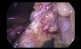 Laparoskopische proximale partielle Gastrektomie nach der DTR-Methode