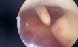 Hysteroskopische Entfernung eines Endometriumpolyps