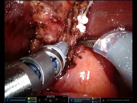 Robotische Cholezystektomie nach schwerer Cholezystitis mit ICG und IOC