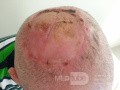 Angiosarkom der Kopfhaut (2)