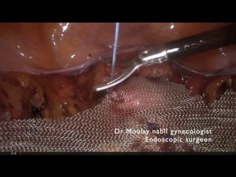 Laparoskopische Pektopexie bei Urogenitalprolaps