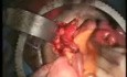 Psoas-Hitch und Boari-Lappen zum vollständigen Ersatz des Ureters