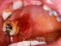 Erythroplakie [Carcinoma in situ]