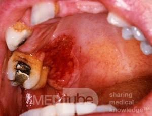 Erythroplakie [Carcinoma in situ]
