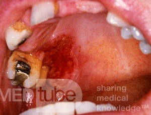 Erythroplakie [Carcinoma in situ]