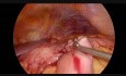 Laparoskopische manuelle gastrointestinale Anastomose und Brown-Anastomose bei fortgeschrittenem Magenkrebs des distalen Teils des Magens