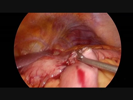 Laparoskopische manuelle gastrointestinale Anastomose und Brown-Anastomose bei fortgeschrittenem Magenkrebs des distalen Teils des Magens