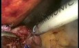 Konversion von der laparoskopischen Nissen-Fundoplikation zum Magen-Bypass mit der Roux-en-Y Methode.