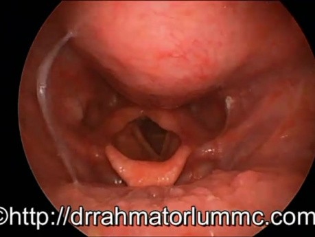 Obstruktion des Larynxeingangs durch einen malignen Tumor des Retropharynx