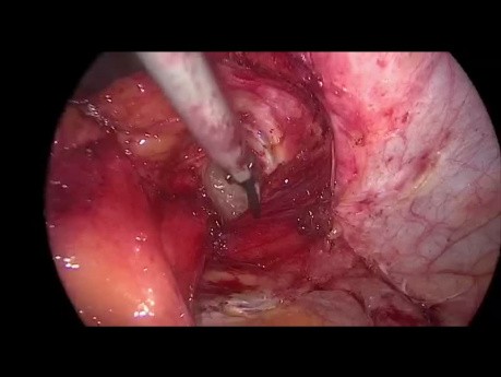 Laparoskopische Operation einer parastomalen Hernie mit der modifizierten Sugarbaker-Methode