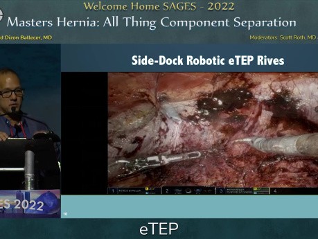 Masters Hernia: Alle Aspekte der Component-Separation – eTEP