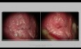 Vulvuläre intraepitheliale Neoplasie VIN 2 bei einer 22-jährigen Frau – Behandlung