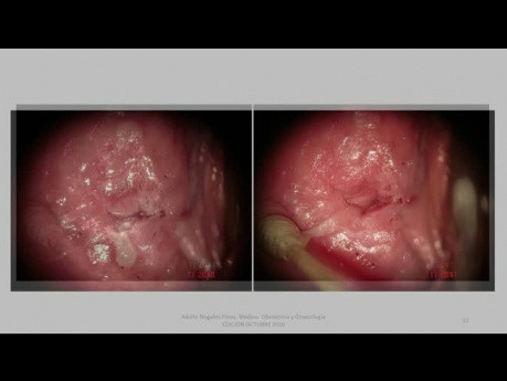 Vulvuläre intraepitheliale Neoplasie VIN 2 bei einer 22-jährigen Frau – Behandlung